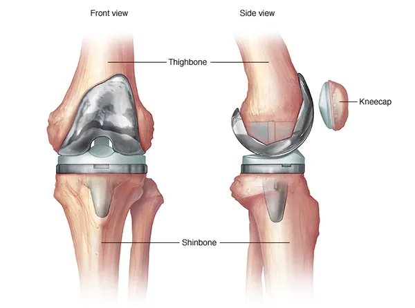 Total Knee Replacement