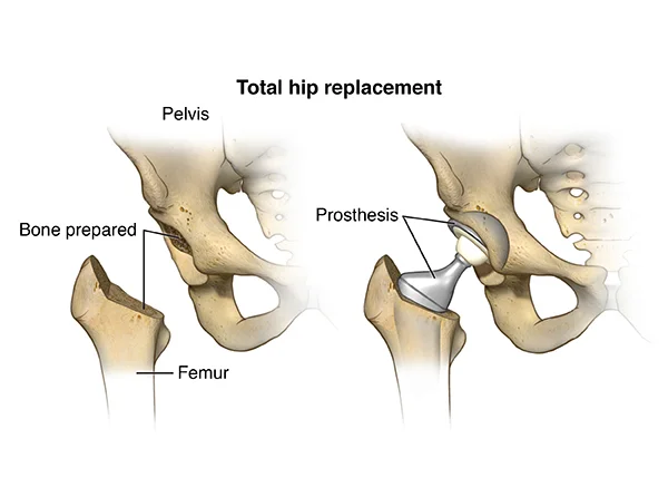 Total Hip Replacement