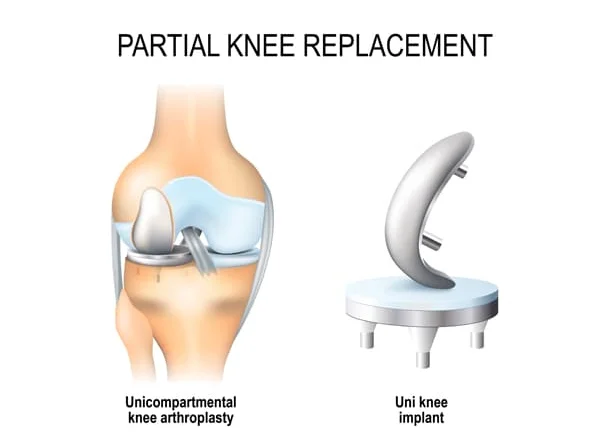 Partial Knee Replacement