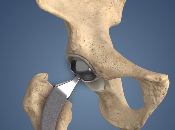 Revision Hip Replacement