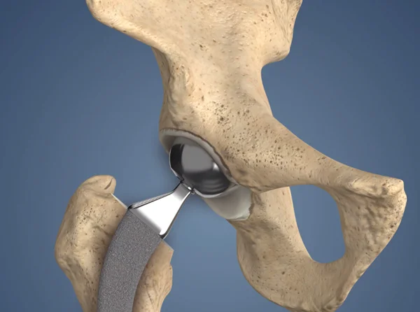 Revision Hip Replacement