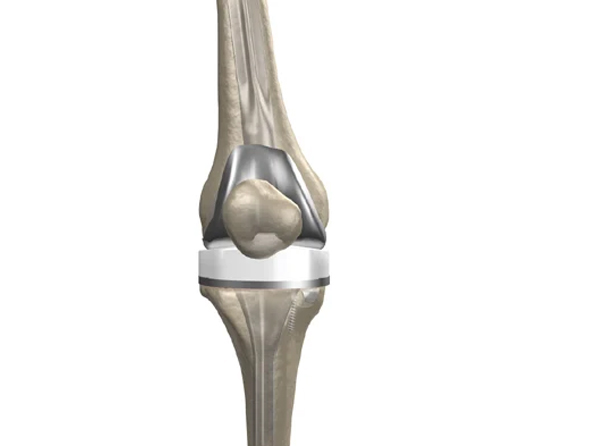 Revision Knee Replacement