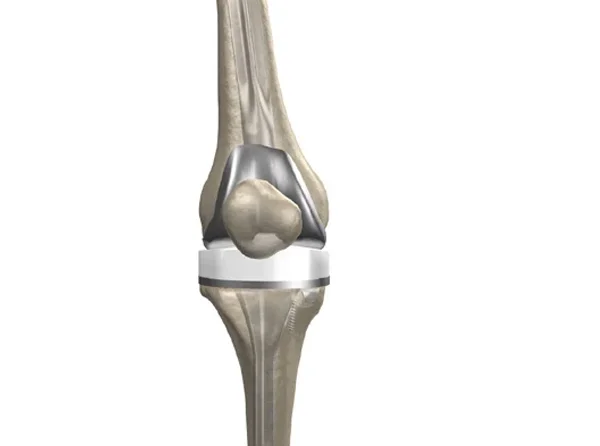 Revision Knee Replacement