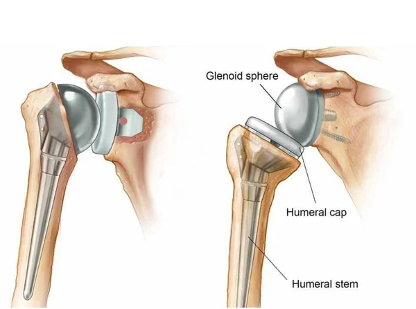 Shoulder Replacement