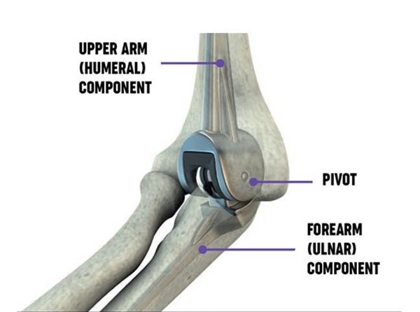 Elbow Replacement