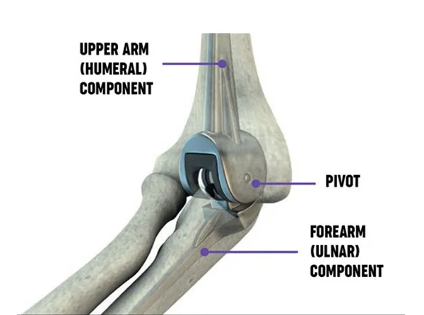 Elbow Replacement