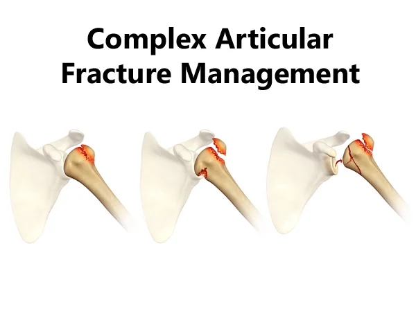  Complex Articular Fracture Management